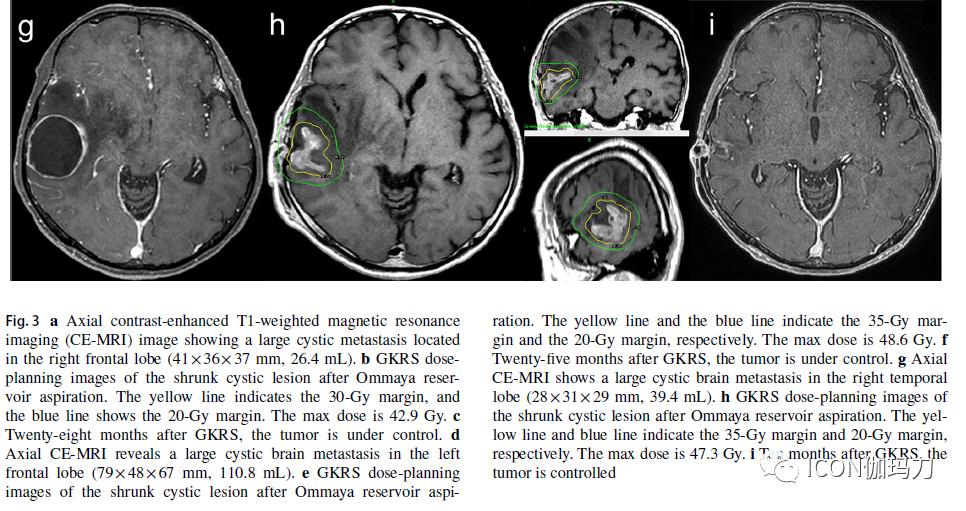 囊肿抽吸后分割伽玛刀放射外科治疗大的囊性脑转移瘤