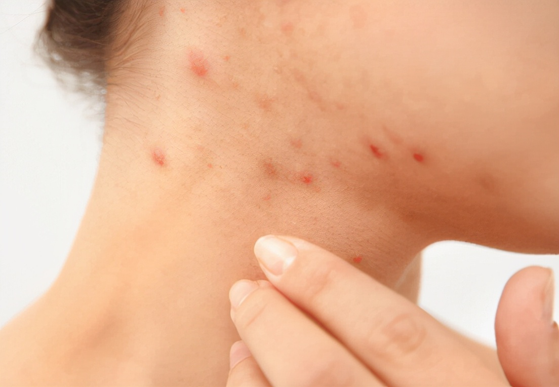 阿奇霉素是杀菌还是抑菌,阿奇霉素是抗菌类药物吗