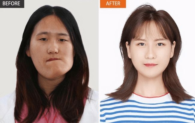 女孩因高烧毁容，后获郭明义帮助整形成功，高颜值引网红公司争抢