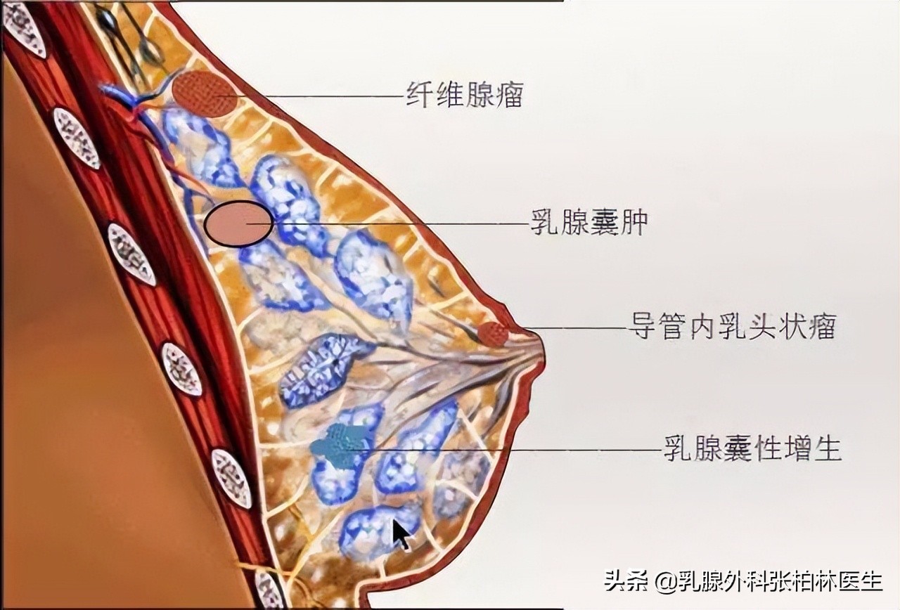 乳房出现这几种胀痛要警惕,乳房胀痛然后有肿块会自愈吗