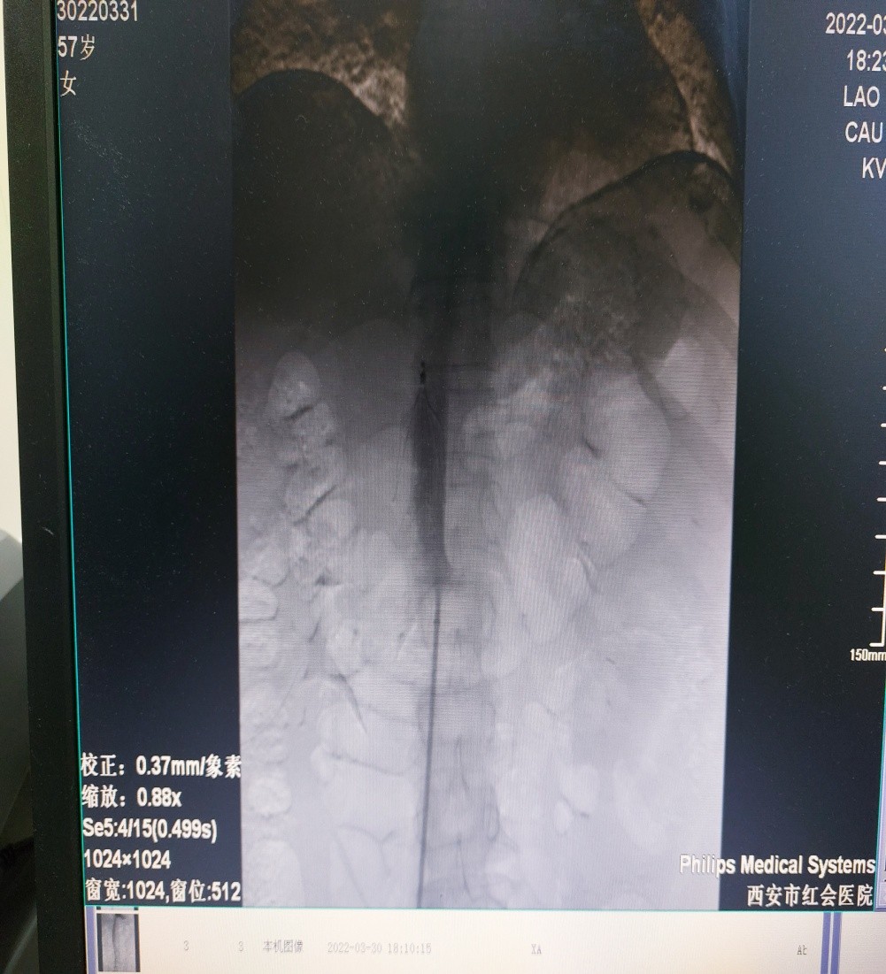 石膏拆了还未消肿怎么回事,长期卧床要注意预防肺栓塞