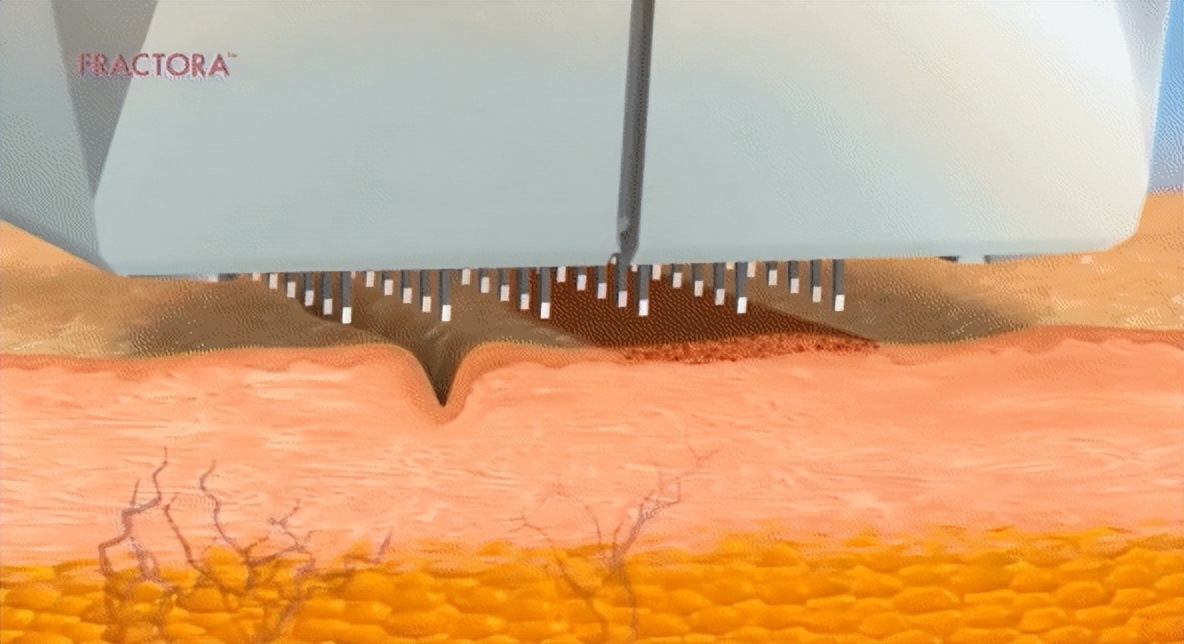 缩小毛孔7个实用方法小技巧,缩小毛孔的最好方法