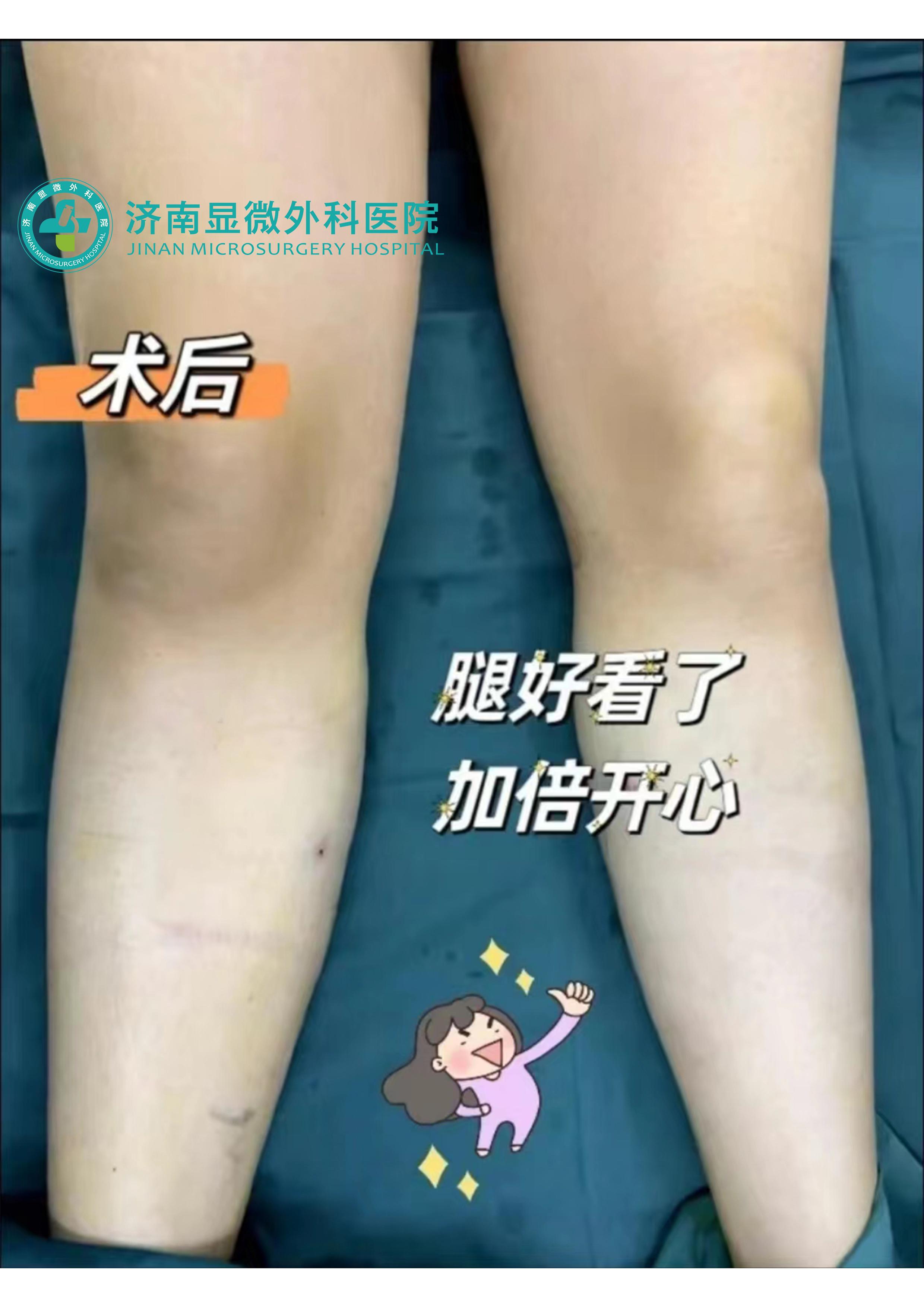 静脉曲张杨医生,静脉曲张微创手术导管消融