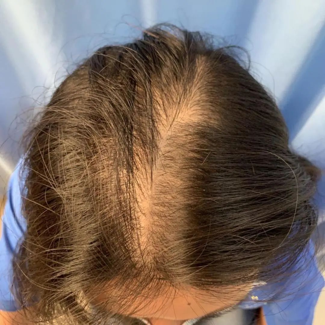 发际线头发稀少吃中药能调节吗,中医治发际线最好的方法