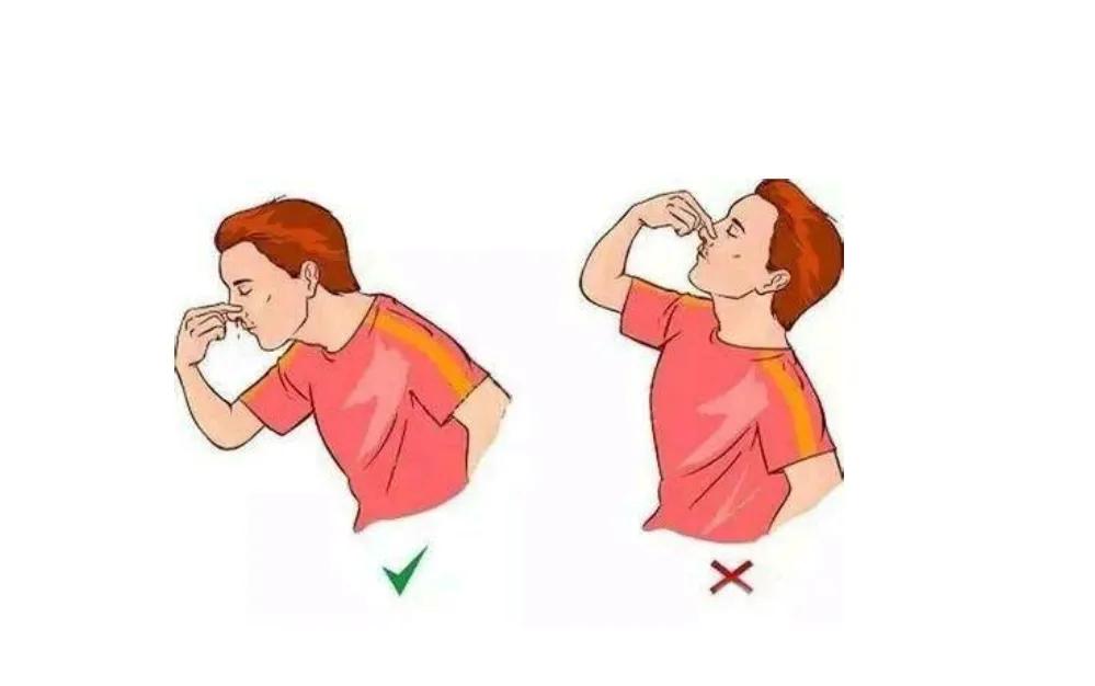 鼻出血介入治疗,鼻出血快速止血