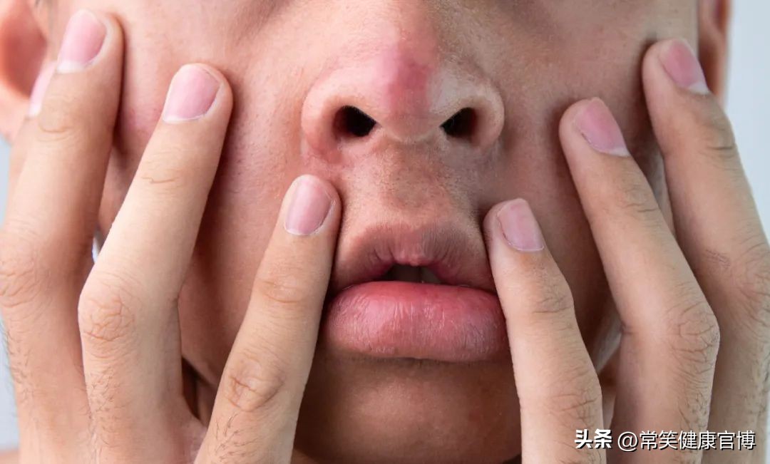 激素依赖性皮炎怎么才可以治愈,激素依赖性皮炎高发期如何缓解