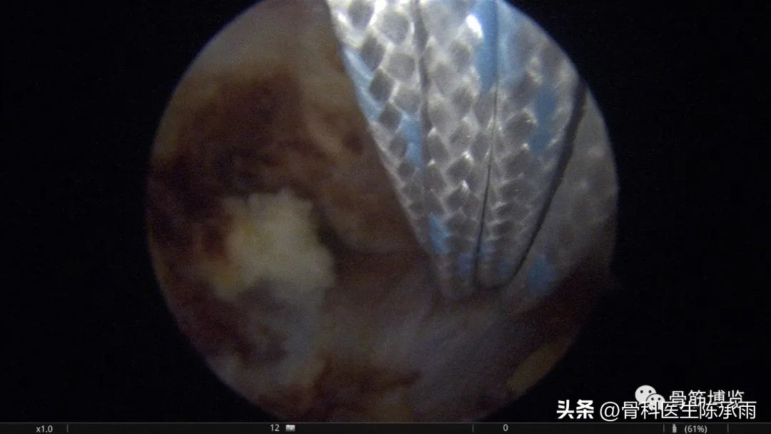 锁骨骨折保守治疗肩关节康复训练,肩锁骨远端骨折保守治疗要多久