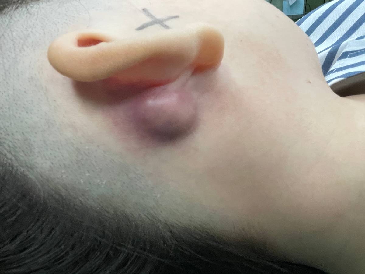 中耳炎一个月了耳朵还发堵,哈尔滨医大一院耳鼻喉科张天虹