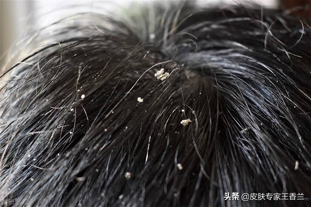 炉甘石洗剂可以用于破损皮肤吗,用完炉甘石洗剂皮肤干燥怎么缓解