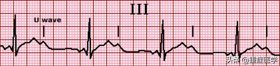 引起成人低钾血症的最主要原因是,治疗成人高钾血症