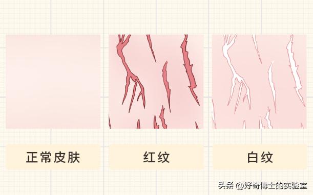 大腿上有白色条纹怎么回事,女生大腿外侧有红条纹是什么原因