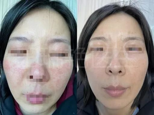 烂脸的警告,烂脸警告