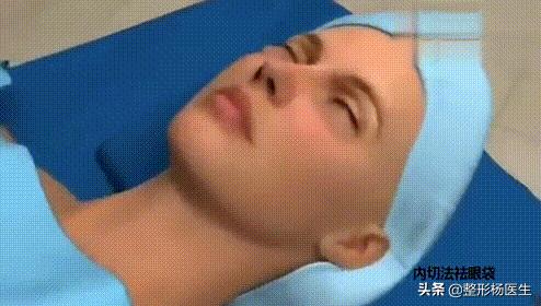 眼袋手术后真的显年轻吗,割眼袋能年轻几岁