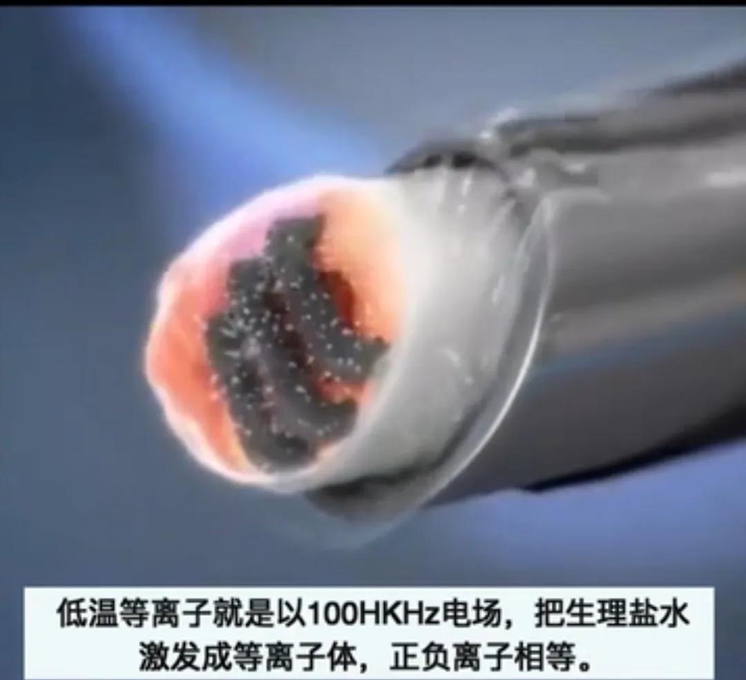 等离子手术的基本原理及优点