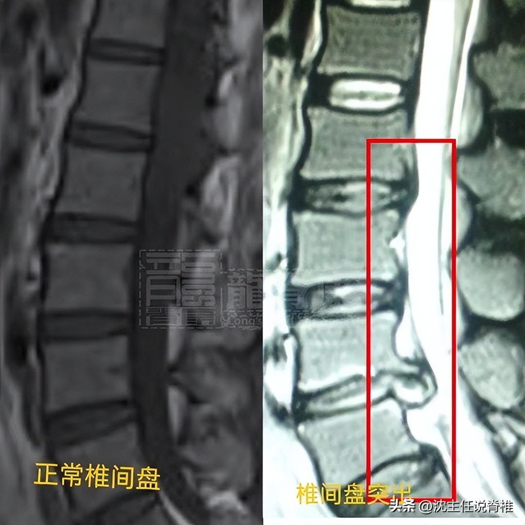 腰椎间盘突出臀部肌肉减少怎么办,腰椎间盘突出引起臀部痛如何治疗