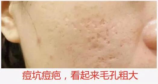 毛孔粗大收缩毛孔最有效的方法,怎么收缩毛孔解决毛孔粗大小妙招