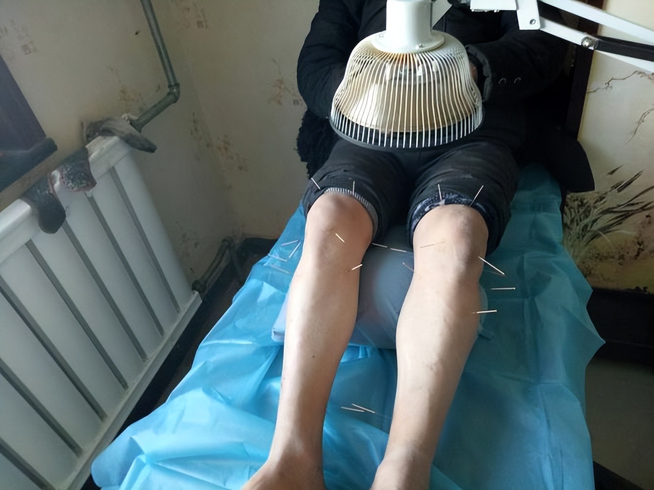 中医针灸治疗颈椎病原理,颈椎病针刀按摩针灸哪种方法好