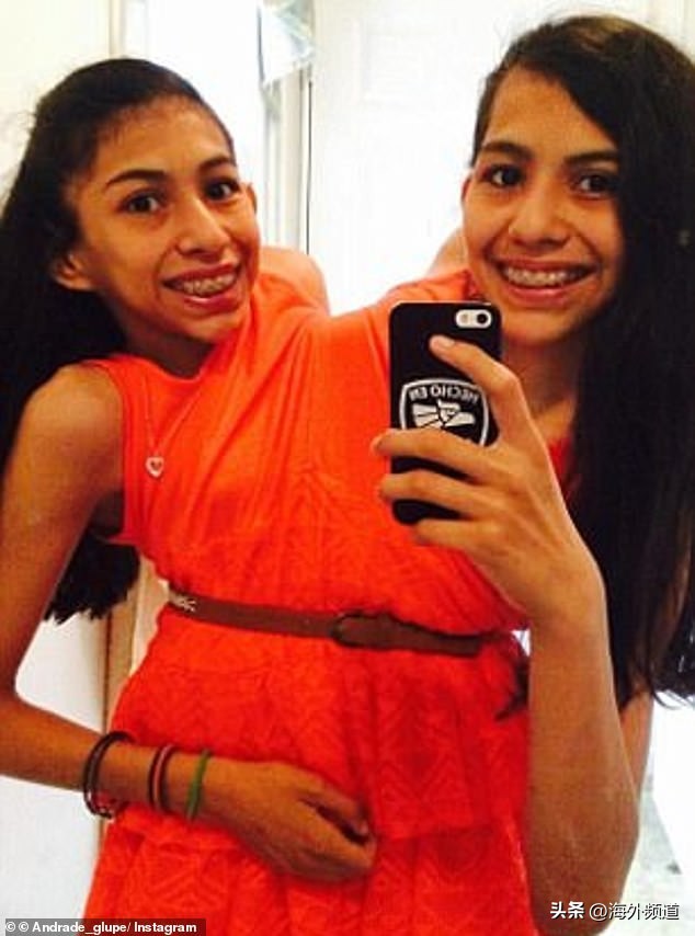 22岁的连体双胞胎姐妹，共享生殖系统，其中一个已交往男朋友两年