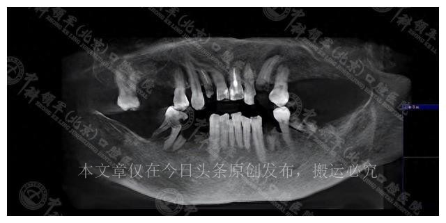 女儿做种植牙手术,老年人做全口种植牙