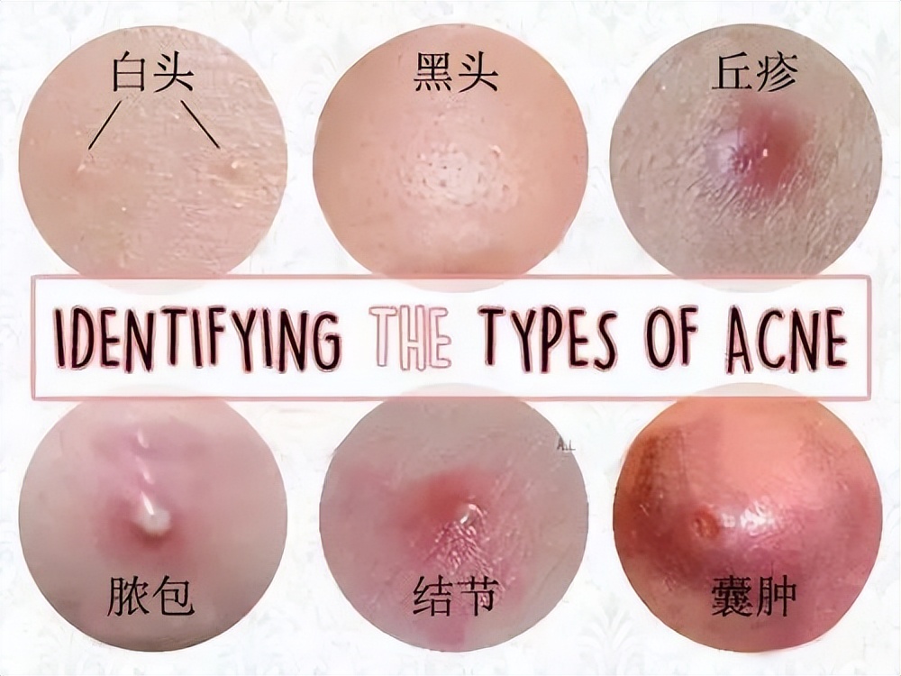 女生痘痘肌怎么养成,痘痘肌女生如何变美