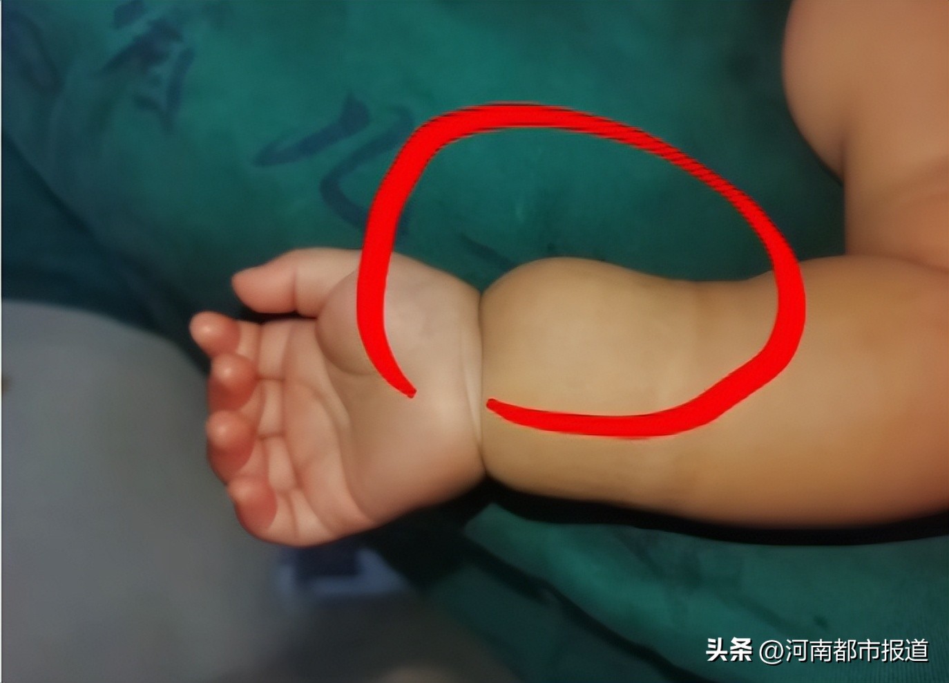 宝宝坠床摔出“动脉瘤”，回老家河南千里寻医