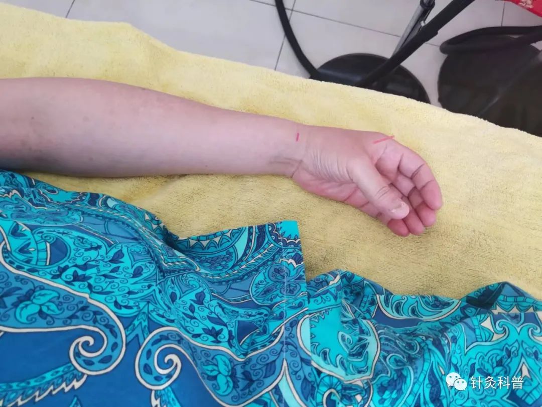 董氏针灸治肾病综合征处方,肾病综合征针灸