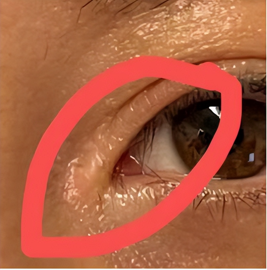 内眦赘皮用手术吗,内眼角内眦赘皮矫正不做手术