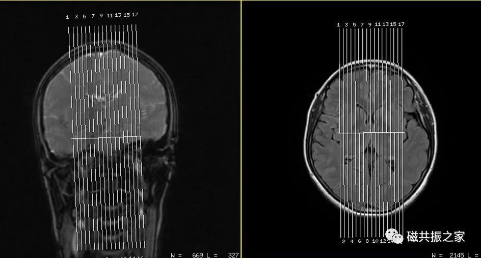 头颅mri的操作步骤,头颅平扫mri能查出什么病