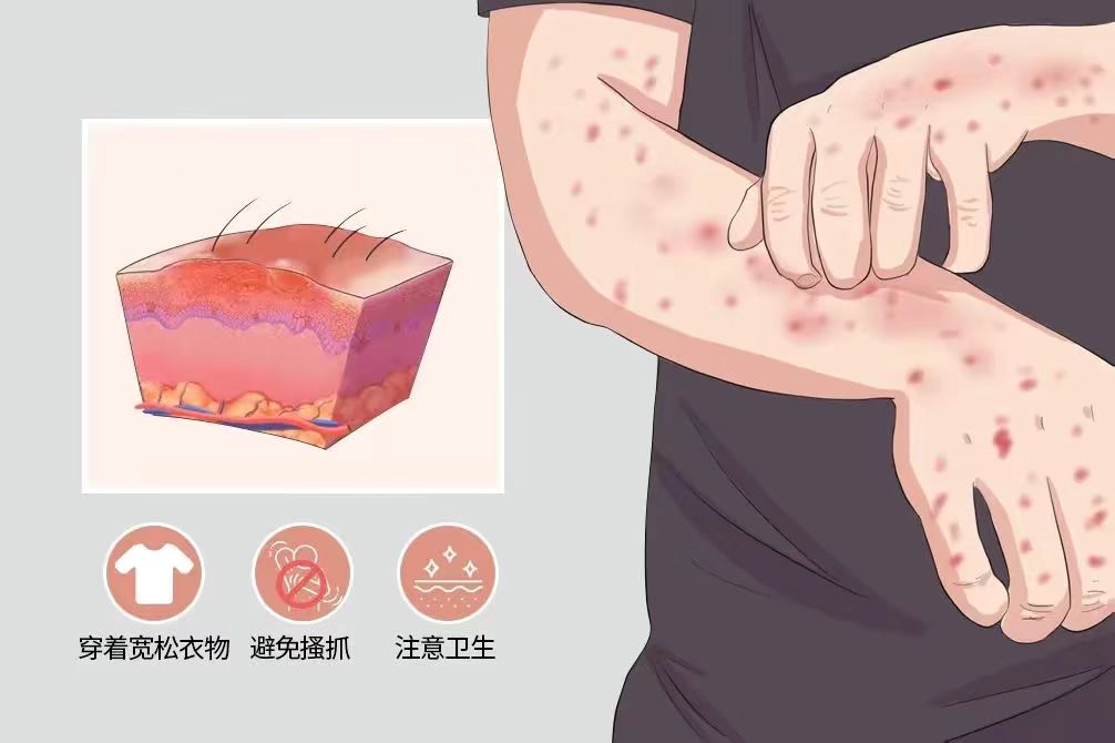 湿疹皮肤瘙痒的中成药,湿疹瘙痒吃中成药
