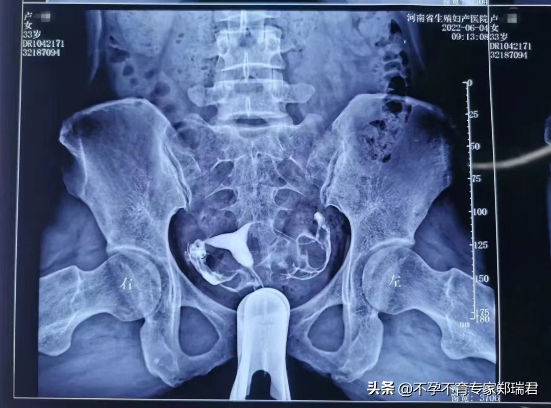 输卵管不通，成功治愈并怀孕