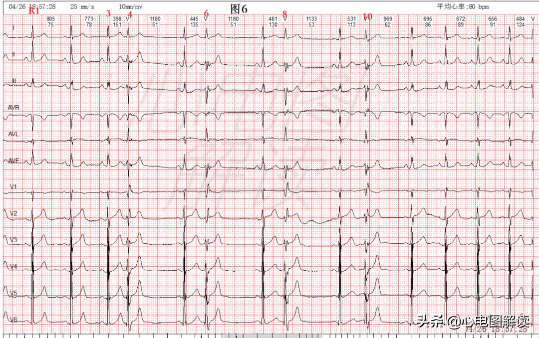 可见室性融合波是什么意思,室性融合波什么意思