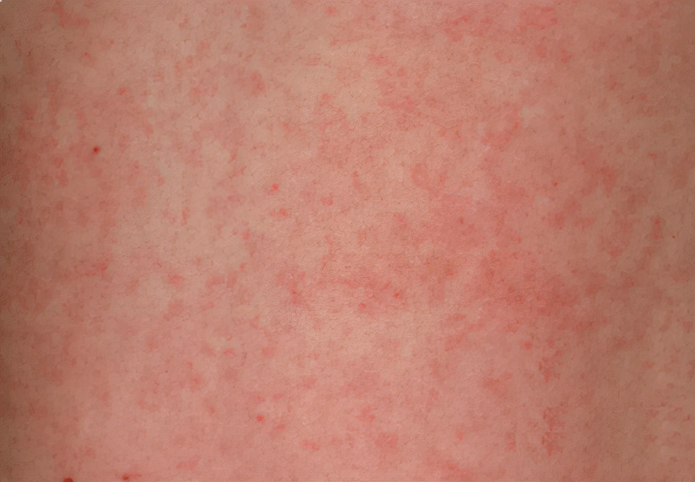 感冒发烧总不好怎么办,感冒发烧一直好不了怎么办