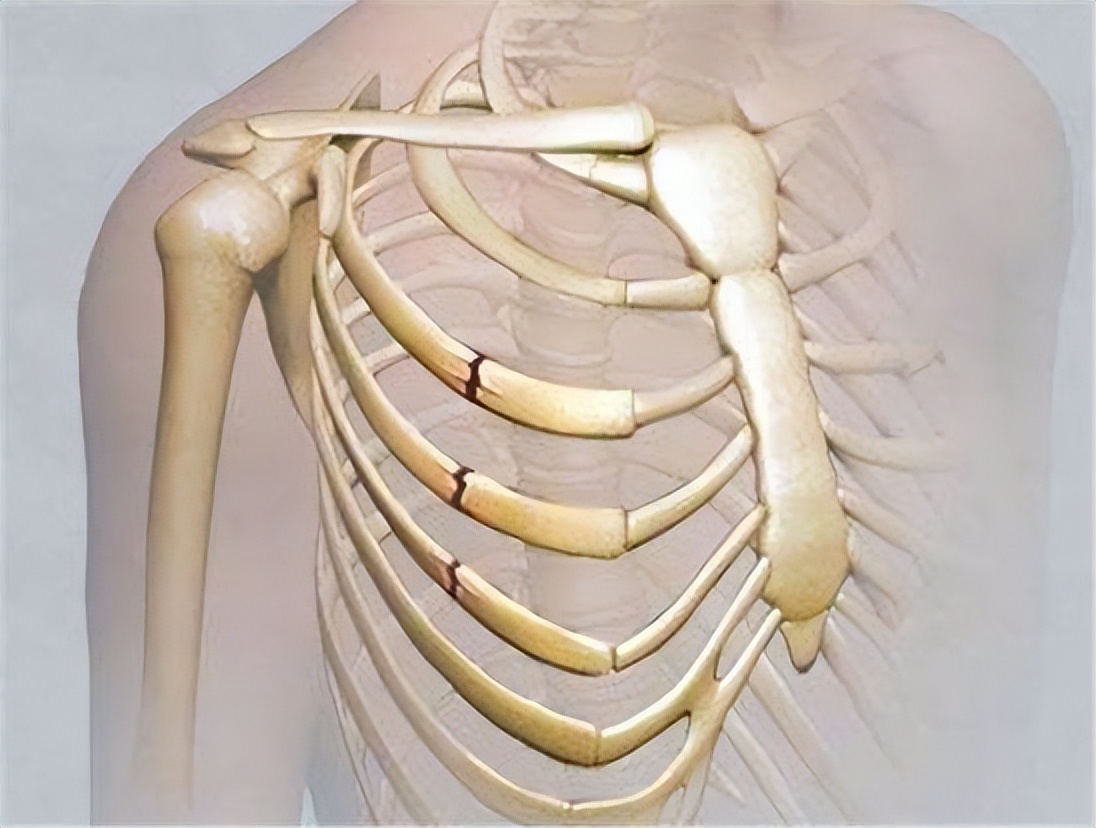 车祸导致的骨折哪里治得好,车祸肋骨骨折的急救措施