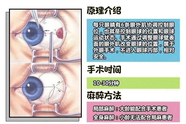 上海儿童斜视手术专家：孩子学龄前，发现斜视要及时治疗