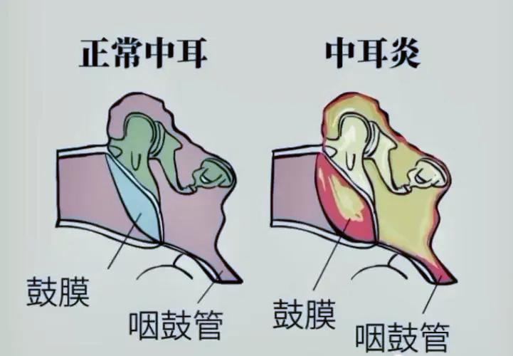 急性中耳炎儿童一边耳朵疼,宝宝急性中耳炎耳朵疼怎么办