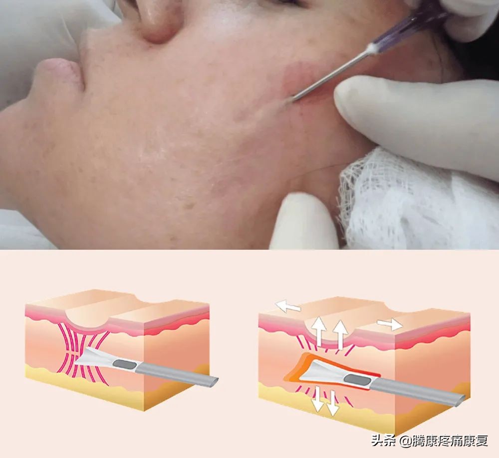 疮疗的后遗症怎么治疗,痤疮留下的瘢痕疙瘩