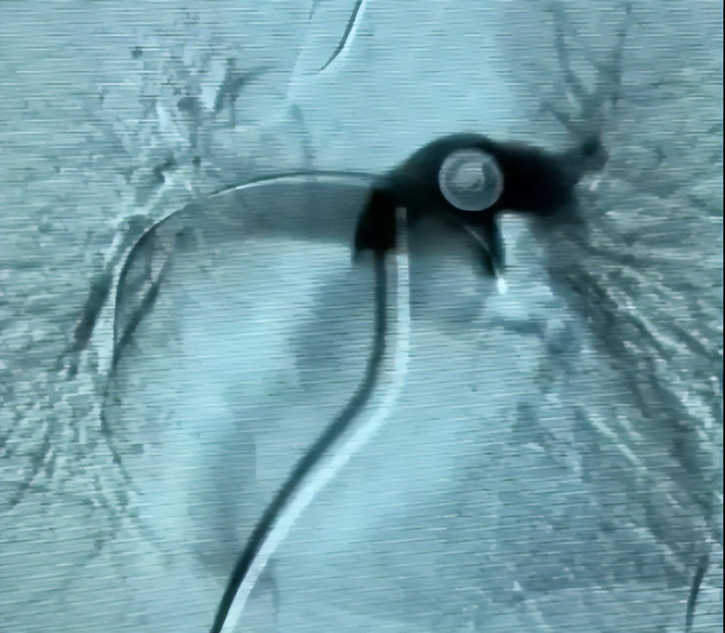 picc拔管遇导管断裂如何处理,picc导管断裂的影像表现