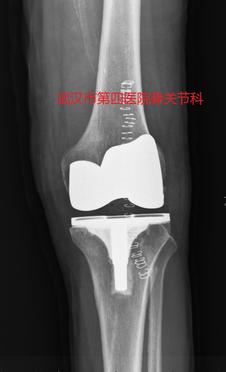 膝关节炎阶梯治疗专家共识,了解膝关节炎的预防和治疗很关键
