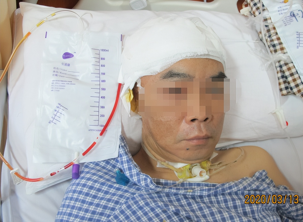 脑动脉瘤破裂手术后有脑水肿,动脉瘤开颅夹闭术出血