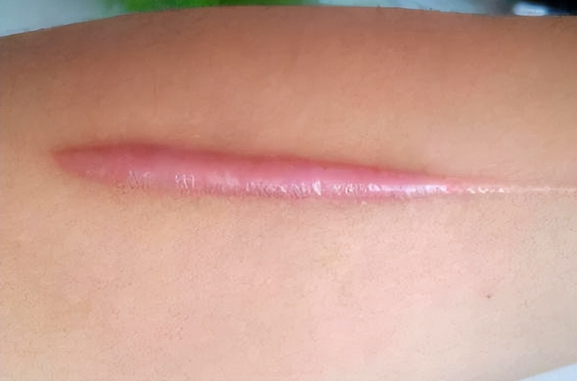 祛疤后疤痕增生怎么办,术后疤痕增生可以不使用祛疤膏吗