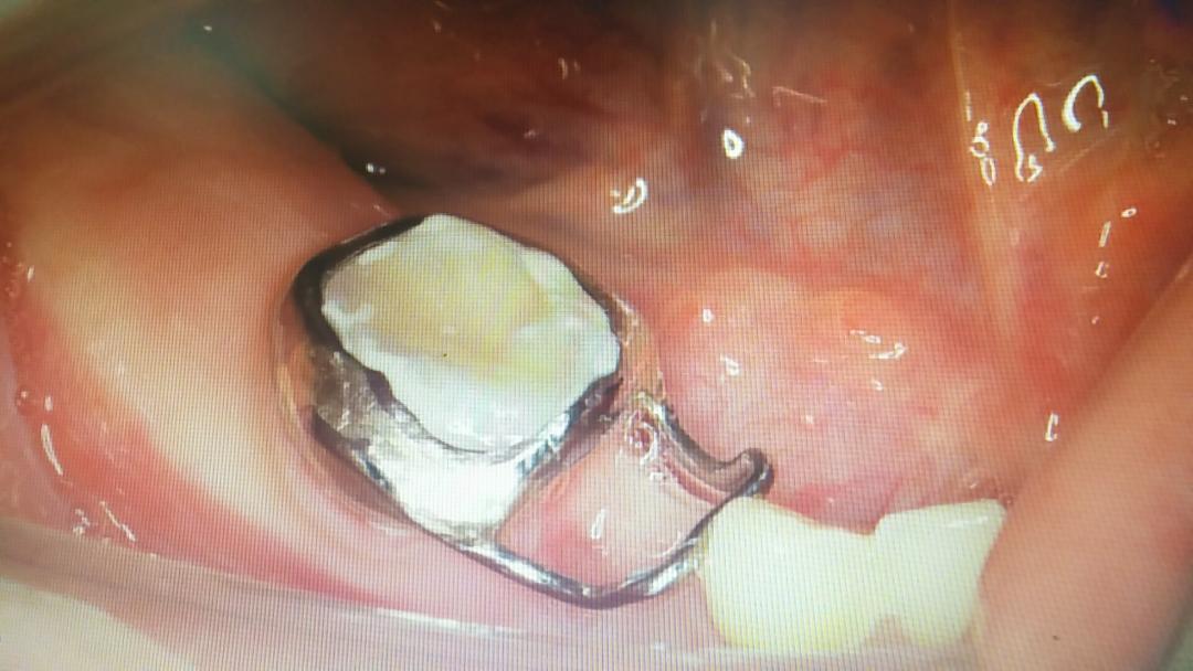 儿童缺牙可以镶牙吗,老年人缺牙后如何镶牙