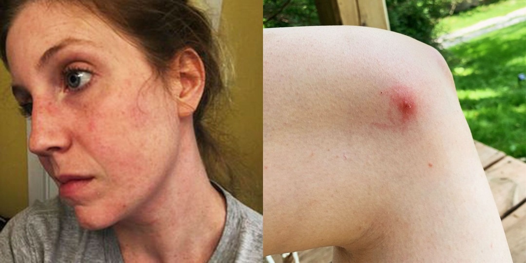 被蜱虫咬能死吗,被蜱虫咬了一辈子不能吃肉吗