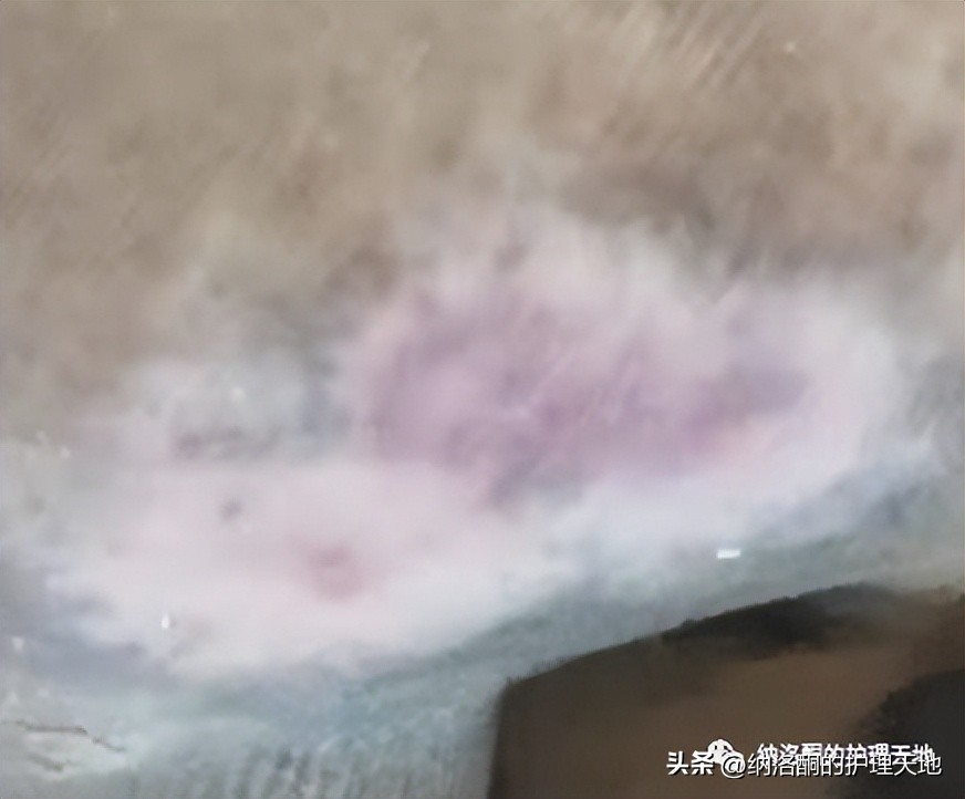 康复新液恢复创面效果怎么样,康复新液可以治疗胃不舒服吗