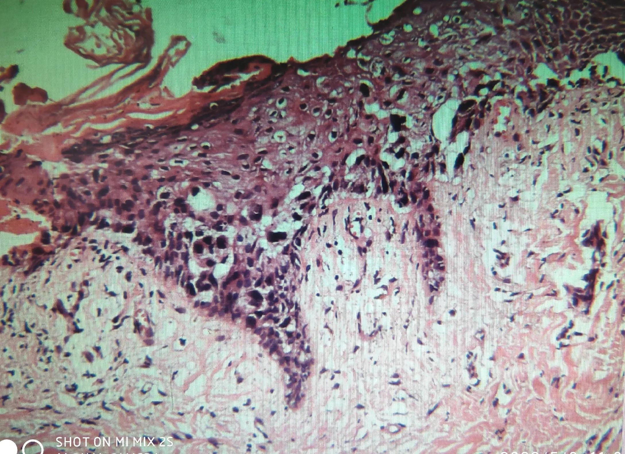 乳头样湿疹,乳头湿疹样病变