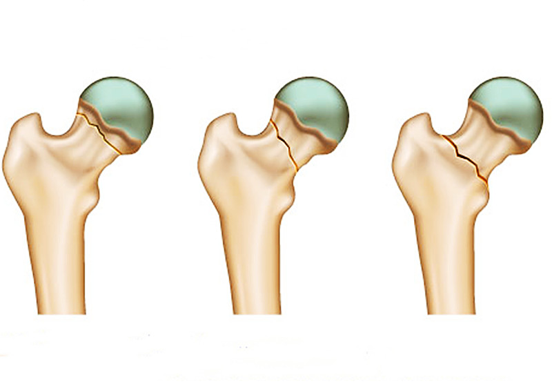 怎么样姿势摔跤引起股骨颈骨折,摔了一跤骶骨疼怎么确认是否骨折