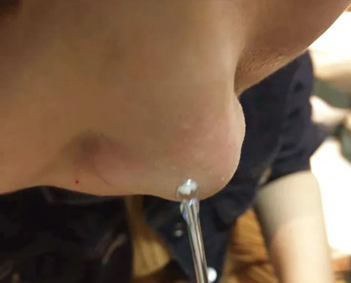 鼻子黑头里挤出的白色油脂怎么办,鼻子上有硬硬的黑头怎么办