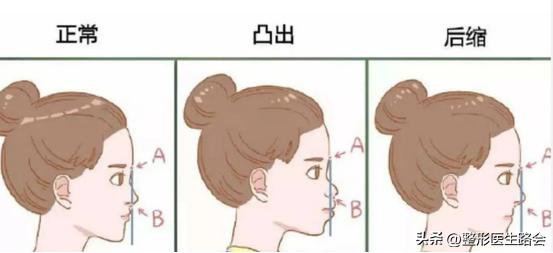 最让人显老的法令纹应该如何解决,法令纹和嘴角纹哪个更显老