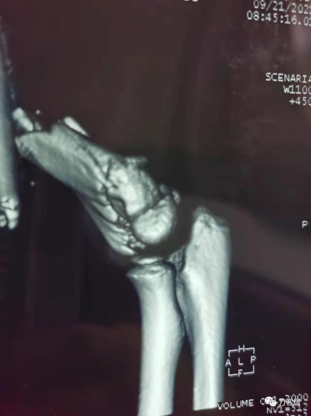 孩子胳膊摔伤肿了不能弯曲一直疼,9岁男孩摔倒手臂痛怎么办