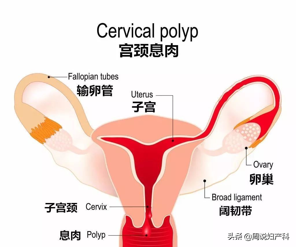 子宫里为什么会长息肉,需要手术吗?