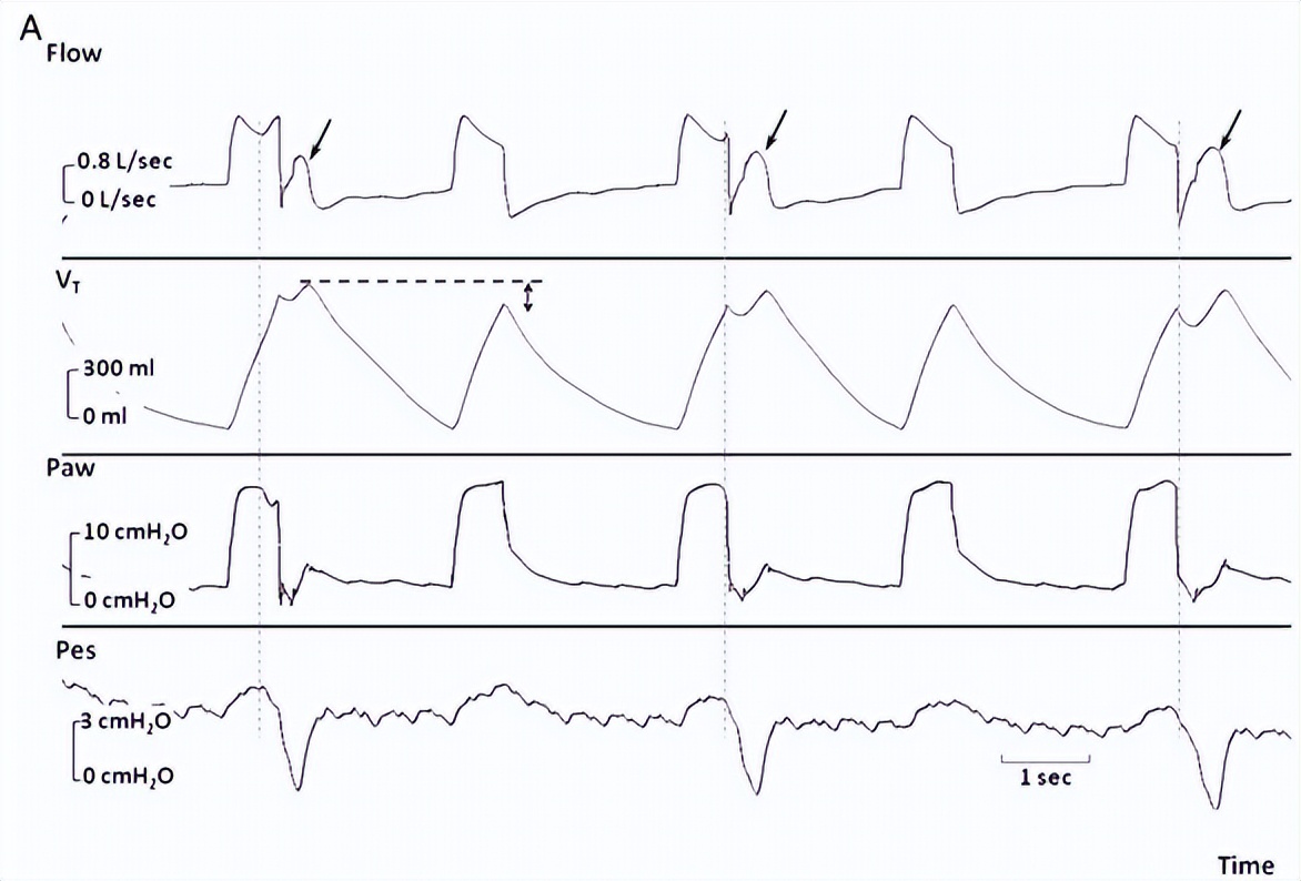 罗红教授,机械通气波形分析和临床应用